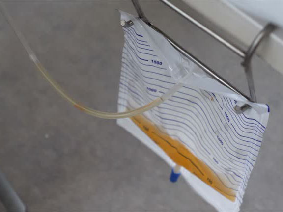 What Is a Urine Drainage Bag