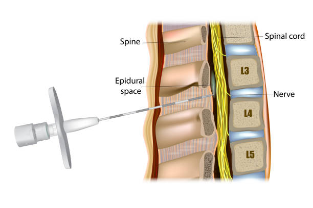 Understanding Epidural Anesthesia Needles: Types, Techniques, and Safety