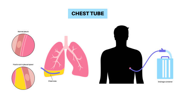 What is a Chest Drainage Tube? Uses, Sizes, and Procurement Guide
