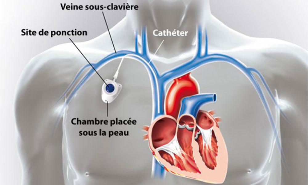 What Is Chemo Port
